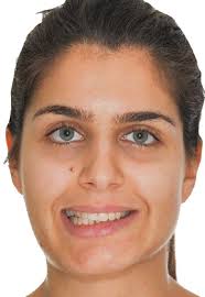 Digital platform for planning facial asymmetry orthodontic-surgical  treatment preparation