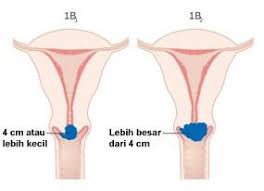 Penatalaksanaan medis pengobatan pada stadium awal, dapat dilakukan operasi sedangkan stadium lanjut hanya dengan. Gejala Kanker Serviks Penyebab Biaya Berobat Dokter Smarter Health