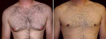 Why Did The Nipple Areola Change Color After Surgery Miguel Delgado Md