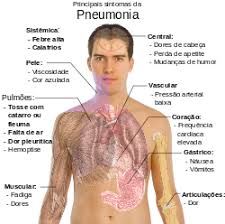 A pneumonia bacteriana normalmente é provocada pela bactéria streptococcus pneumoniae durante o tratamento da pneumonia, o paciente deve tomar alguns cuidados com sua saúde, para. Pneumonia Wikipedia A Enciclopedia Livre