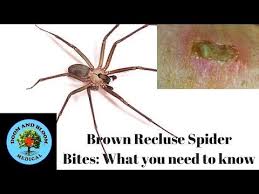 What To Know About Brown Recluse Spider Bites Video Rethinksurvival Com Hike Trips Fun Brown Recluse Spider Bite Brown Recluse Brown Recluse Spider