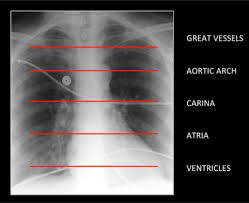 Anatomies like brain, temporal bone/internal auditory meatus, nasopharynx, orbit, paranasal sinuses, cranial nerves, temporomandibular joint. Computed Tomography Of The Chest I Basic Principles Bja Education