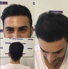 Medical Hair Sibel Ulusan Izmir Turkey Hairtransplant Hairtransplantistanbul Hairtransplantdocto Hair Transplant Uk Hair Transplant Surgery Hair Transplant