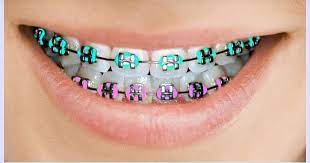 Has been added to your cart. Colored Braces And Bands Murray Orthodontics