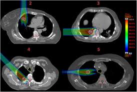 Kilian baumann is on twitter known as @kilian_baumann. Effects Of The Bragg Peak Degradation Due To Lung Tissue In Proton Therapy Of Lung Cancer Patients Radiation Oncology Full Text