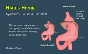 Image result for stomach hernia symptoms