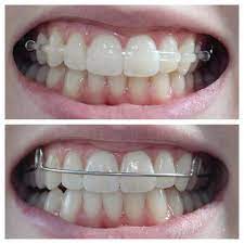 Art Orthodontic Laboratory Dental Braces Teeth Braces Teeth Straightening