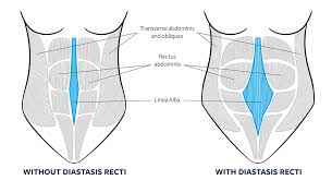 How to fix diastasis recti at home. Does Everyone Get Diastasis Recti During Pregnancy Girls Gone Strong