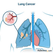 The pancreas is an organ that releases enzymes involved with digestion, and hormones to regular blood sugar levels. Asbestos Cancer Mesothelioma Lung Cancer Other Cancers