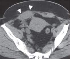 Abdominal ct scan is a diagnostic imaging technique that provides a clear picture of the state of ct scan results may detect certain abnormalities in the abdominal area which may be due to various reasons. C 41 Year Old Woman With Abdominal Wall Endometriosis Unenhanced Ct Download Scientific Diagram