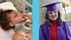 Teen's Onset of Epilepsy Linked to Prior Brain Injury