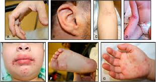 We did not find results for: Atypical Hand Foot And Mouth Disease Associated With Coxsackievirus A6 Infection Journal Of The American Academy Of Dermatology