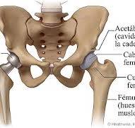 Artroplastia parcial de cadera