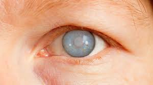 Algunas personas tienen otros tipos de la enfermedad. Glaucoma Oftalmologia Especializada
