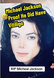 Michael Jackson Vitiligo Pictures