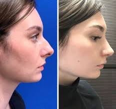 What's it like to go from being unattractive to gorgeous? 20 People That Got Plastic Surgery And Are Rocking Their New Looks Bright Side