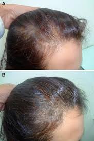 They were randomly allocated to three groups receiving each one of the three shampoos in the market containing either 1% ketoconazole (ktz), 1% piroctone olamine (pto) or 1% zinc pyrithione (zpt). Controlled Clinical Trial For Evaluation Of Hair Growth With Low Dose Cyclical Nutrition Therapy In Men And Women Without The Use Of Finasteride