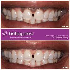 The Alternative To Gum Bleaching Stanley Britegums