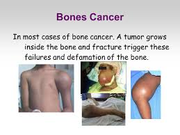 But that is changing thanks to people like you and thanks to people like all the people that are around trying to. Bones Cancer The Primary Bone Cancer Is A Rare Type Of Cancer That Affects The Human Skeleton Unlike The Secondary Originates In The Bone And Not The Ppt Download