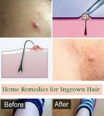 In males, ingrown hair cysts usually affect chin, cheeks, under neck region due to frequent removal of consequently, too tight clothing can cause ingrown hair cysts on inner thighs, legs, and pubic can an ingrown hair cyst refuse to go away from the skin? 9 Ingrown Hair Ideas Ingrown Hair Ingrown Hair Remedies Ingrown Hair Removal