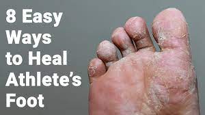 Easy Athlete S Foot Treatment Album On Imgur