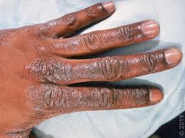 Image result for Atopic eczema atopic dermatitis