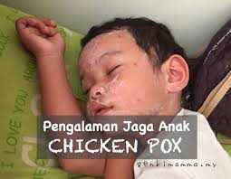 Chickenpox is an infection caused by the varicella zoster virus. Pengalaman Jaga Anak Chicken Pox Genkimomma My