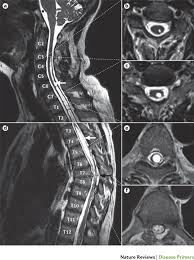 Image result for Spinal Trauma