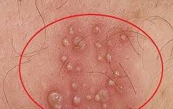 Minggu, 09 mei 2021 17:02. Tata Cara Mengobati Sipilis Kencing Nanah Yg Ampuh Obat Sipilis De Nature Aman Dan Ampuh Tanpa Suntik