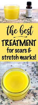 Stretch marks are common, these therefore, in this article, i'm going to detail out the recipe to formulate a diy stretch marks cream to minimize the appearance and texture of. 42 Best Diy Stretch Marks Cream Ideas Stretch Marks Diy Stretch Marks Cream Marks Cream