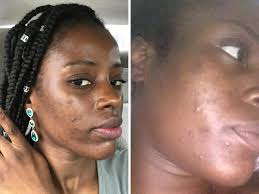 Thorough cleansing keeps the skin free of excess oil, dirt, sweat, and makeup, and leaves a nice, clean base for your acne treatment products. The Best Skin Care Routine For Oily Acne Prone Skin