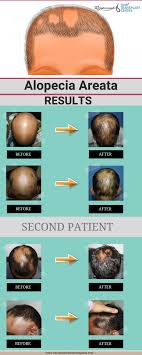 Although the cause of hair loss is easily diagnosed in an overview of the basic principles of hair biology, potential causes of hair loss, and the assessment of patients who present with a complaint of hair. Pin On Hair Loss Treatment