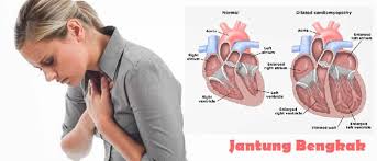Penyakit jantung koroner (pjk) terjadi ketika pembuluh darah arteri yang mengalirkan darah ke jantung mengeras dan mengalami penyempitan. Penyebab Gejala Dan Komplikasi Penyakit Jantung Bengkak Website Desa Ciburial