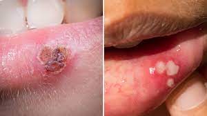 Infection with herpes simplex virus (hsv) is one of the most common infections in the world—and one of the most confusing. Herpes Simplex 1 Vs Herpes Simplex 2 Health Com