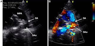 Healthcare | Free Full-Text | Screening Of Coronary Artery Origin By  Echocardiography: Definition Of Normal (And Abnormal) Take-Off By Standard  Echocardiographic Views In A Healthy Pediatric Population