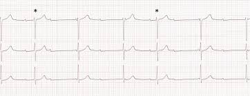 Cardiovascular Medicine Acute Management Of Bradycardia In The Emergency Setting