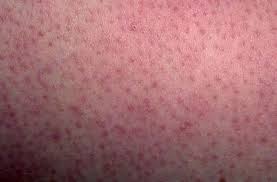 Red Hair Follicles Skin Bumps Dry Bumpy Skin Dry Skin On Face