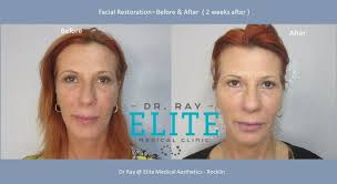 Use lasers, botox, fillers and more to remove wrinkles, transplant or remove hair, . Best Botox Liposuction Dr Ray Medical Aesthetics Rocklin