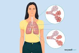 Image result for Emphysema