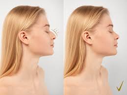 Rhinoplasty | How Much Does this Really Cost? 2025