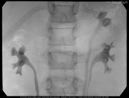 Yeah but where they do the vcug is in a different hole than where you have sex. Medpix Case Vesicoureteral Reflux Left Partial Duplex Renal Collecting System With Low Bifid Ureter