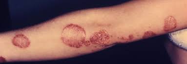 Psoriasis Therapy Improves Joint And Skin Symptoms Of Psoriatic Arthritis The Dermatologist