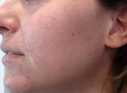 10:34 μμ, σαββατο 29 μάι 2021 10:34 μμ, 29 μάι 2021. Fractional Laser 8essalonikh Serres Dr Eyaggelos Aktsalhs