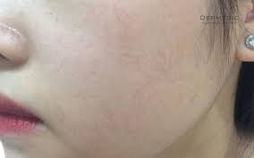 DA MỎNG LỘ MAO MẠCH LÀ GÌ? NÊN CHĂM SÓC DA MẶT MỎNG NỔI MẠCH THẾ NÀO? –  DERMEDIC VIETNAM