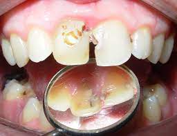 Caries Dentales En El Sector Anterior Vista Palatina Food Breakfast