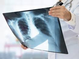 Dacă vorbim despre imaginea clinică, este complet diferită în fiecare caz. Cancerul Pulmonar Greu De Tratat In Romania Romania Libera