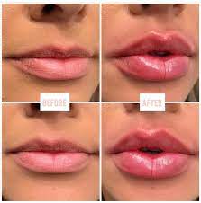 Check spelling or type a new query. Best Of Full Syringe Of Juvederm In Top Lip And Description Botox Lips Lip Injections Juvederm Lip Fillers Juvederm