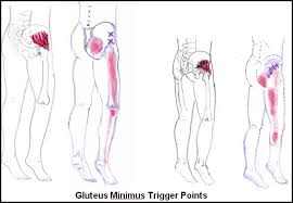 Lower Back Pain Trigger Points