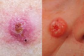 Basal cell carcinoma growth rate: Skin Cancer Pictures 5 Different Types Of Skin Cancer To Know