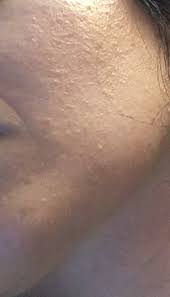 We did not find results for: Routine Help Skin Colored Bumps Rough Uneven Skin Texture Skincareaddiction